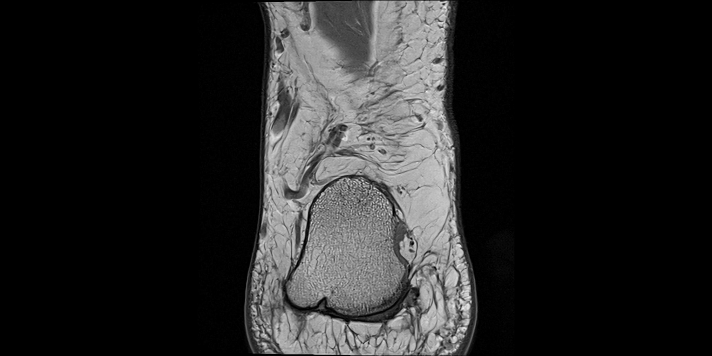 MRI Ankle coronal ligaments cross sectional anatomy 3T  radiology  image-img-00001-00025.webp